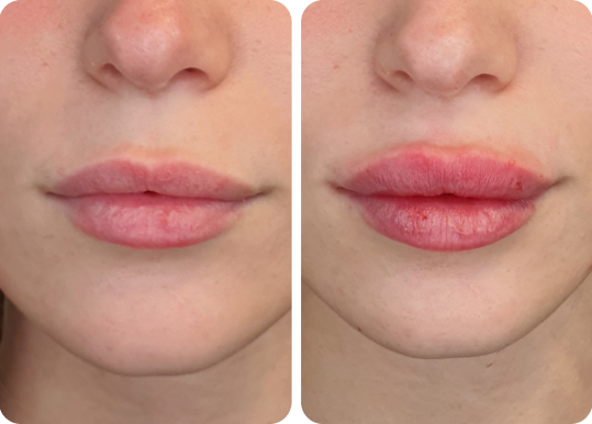 טיפול עיצוב שפתיים